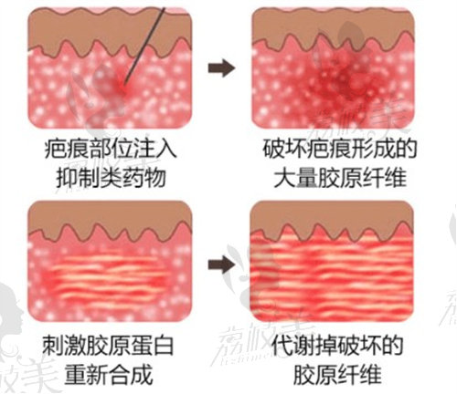 疤痕软化针作用原理