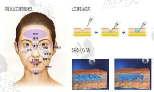 玻尿酸常見注射部位