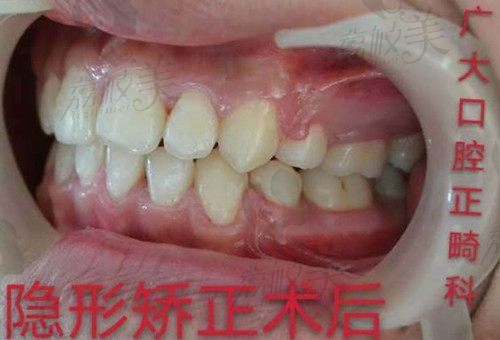 广州广大口腔牙齿矫正病例