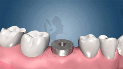 朱众欢医生种牙的技术优势1