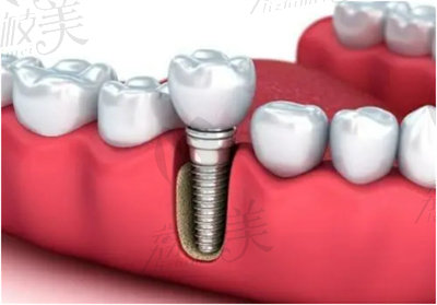 朱众欢医生种牙的技术优势2