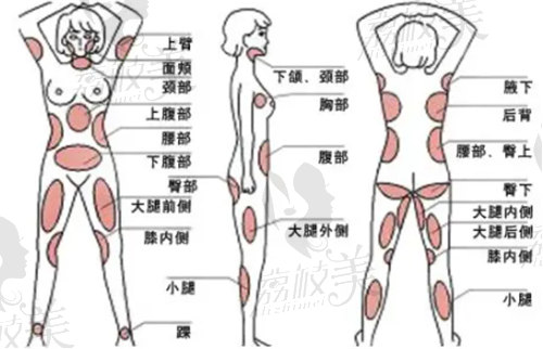 徐少骏医生说的可吸脂部位