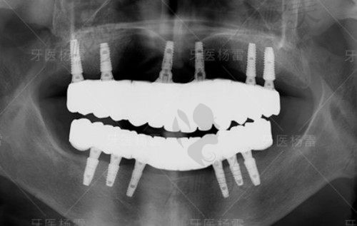 北京斯迈尔口腔种植牙病例