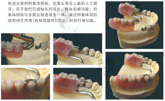 北京冠美口腔附着义齿技术