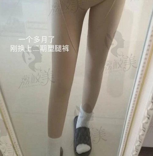 卢九宁直腿术后反馈