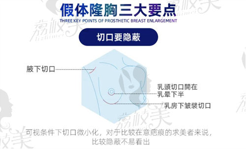 假体隆胸三大要点