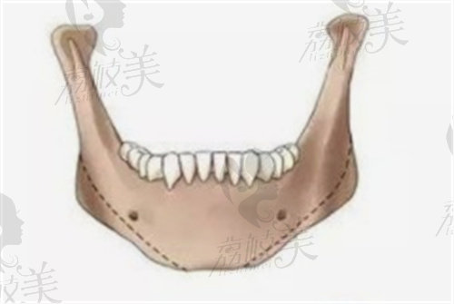 徐威强医生下颌角示意图
