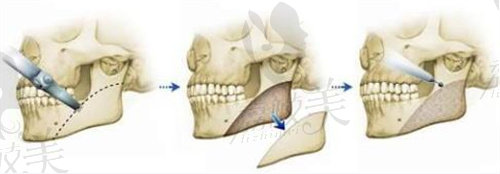 下颌角截骨流程