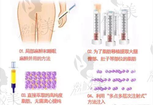 北京东方和谐王自谦自体脂肪移植过程