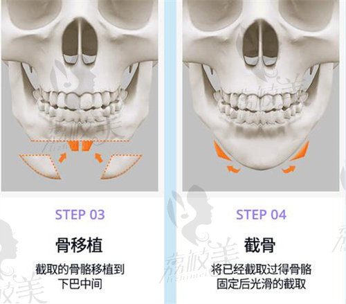 下巴延長完成