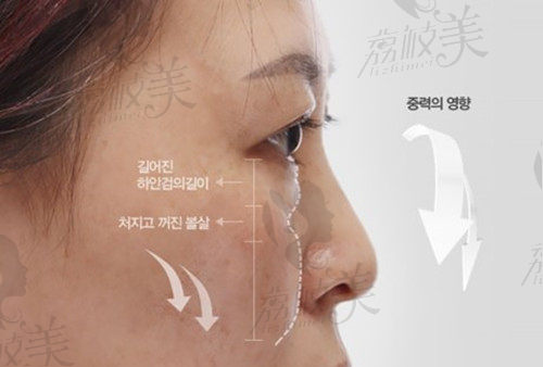 韩国大眼睛整形医院高汉雄院长做下眼睑提升术
