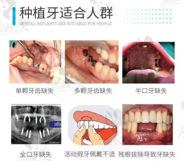 深圳拜爾口腔種植牙