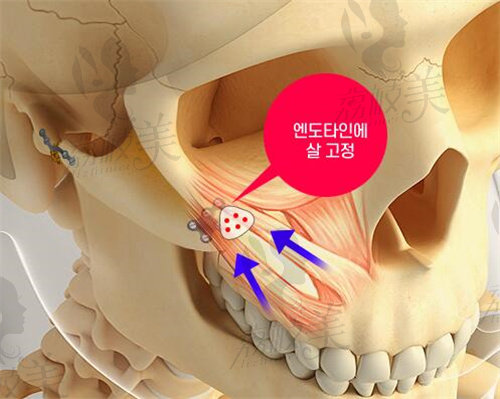 韩国1%整形颧骨技术