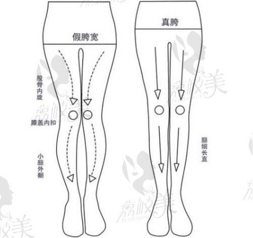 北京华意O型腿矫正