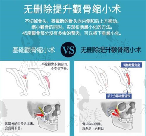 無(wú)刪除提升顴骨縮小術(shù)