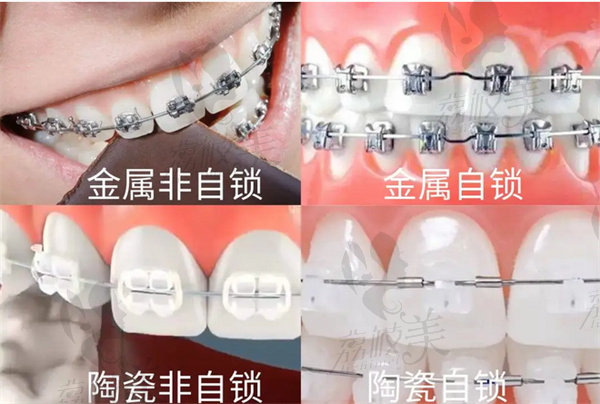 自锁牙套和普通牙套的区别在哪里？价格,优缺点和成效PK打包送你
