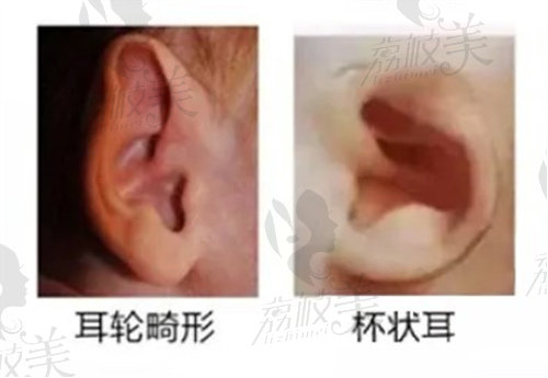 耳廓缺损的表现形式