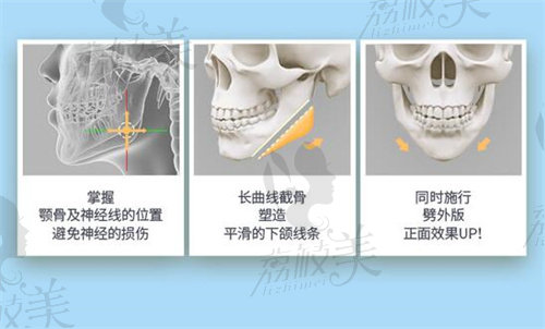 李湘雨下頜角截骨特色