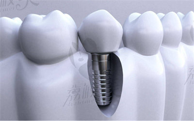 谭政医生做微创种植牙手术的技术优势