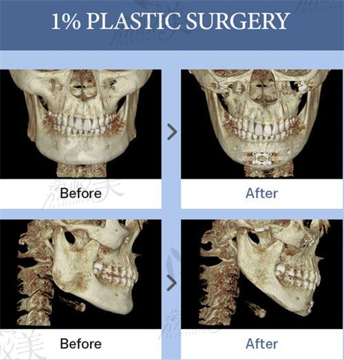 韩国1%整形外科下颌截骨前后
