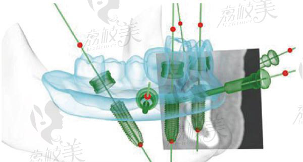 3d导板种植牙技术