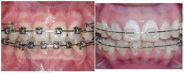牙齿矫正前后对比