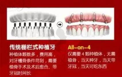传统种植牙和即刻种植牙技术的区别