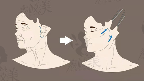 拉皮手术要找好医生来做