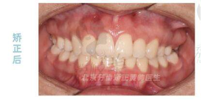 牙齿矫正后的术后疗效