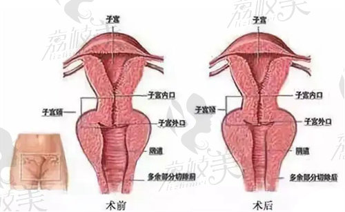 南京新秀私密整形3D生物束带优势