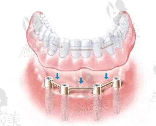 All-on-4种植牙