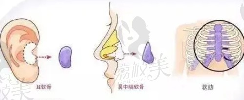 鼻子假體提取處