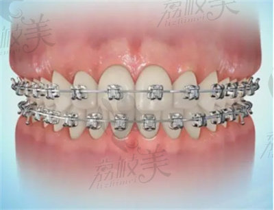 温朋兵医生做牙齿矫正的技术优势2