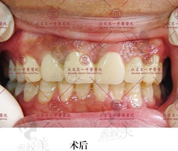 京一口腔多生牙矯正用戶反饋