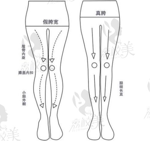 北京直腿术哪家医院好?公开北京直腿成形术好的医院医生名单
