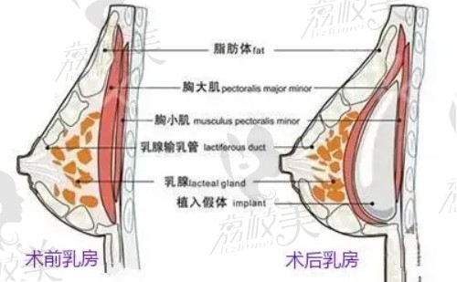 隆胸圖解