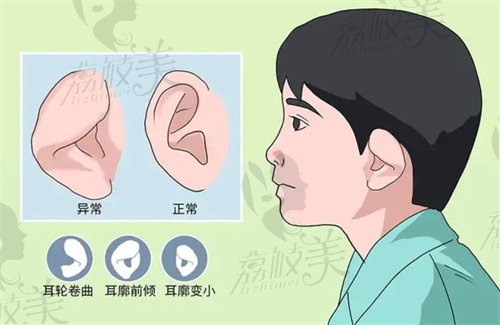 杯状耳示意图