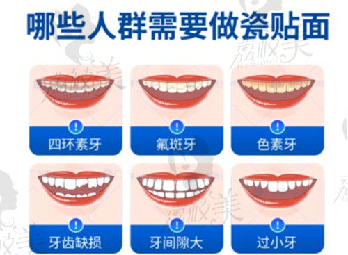 牙贴面适应人群