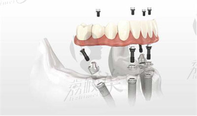 孙可墨医生做all-on-4种植牙手术的技术优势1