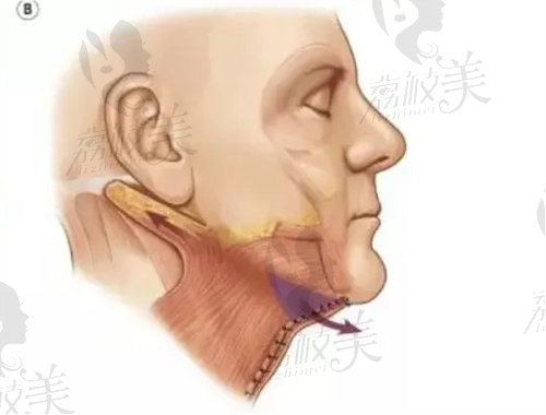 頸闊肌成形術(shù)示意圖