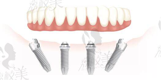 微創(chuàng)過程 All-on-4手術(shù)技術(shù) 