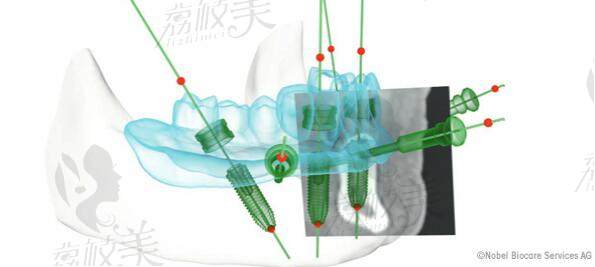 微創(chuàng)過程 All-on-4手術(shù)技術(shù) 原理