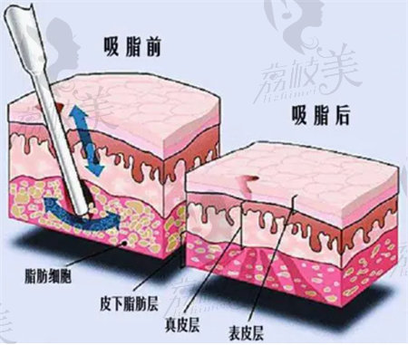 吸脂前后