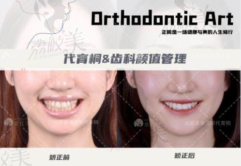 成都马泷口腔代育桐院长的二次矫正病例