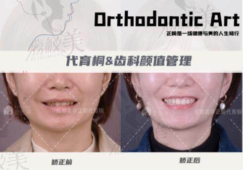 成都马泷口腔代育桐院长的二次矫正病例