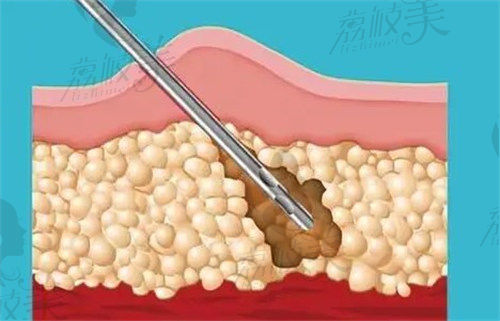 蒲小兵吸脂示意图