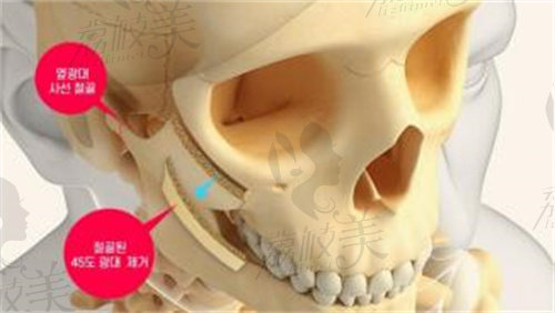 韩国1%整形外科HIGH-3D颧骨