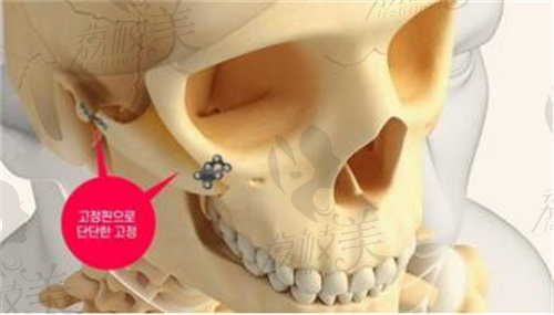 HIGH-3D颧骨术固定术