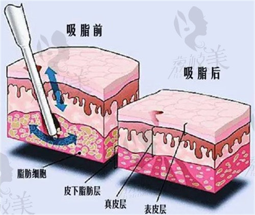 吸脂示意图