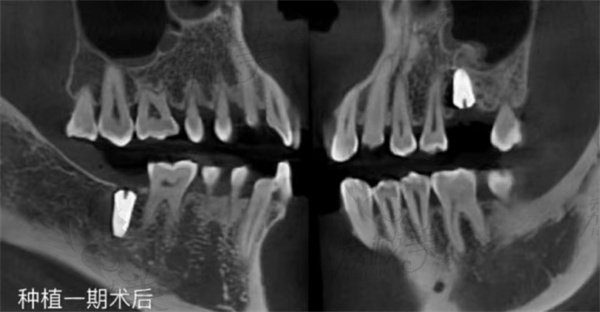 江門松鼠口腔種植牙術(shù)后